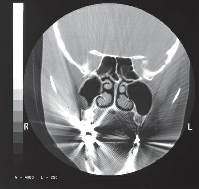 <p>Which of the following would be the most common cause of</p><p>the artifact in the figure?</p><p>a. metallic dental fillings</p><p>b. partial volume averaging</p><p>c. beam hardening</p><p>d. detector malfunction</p>