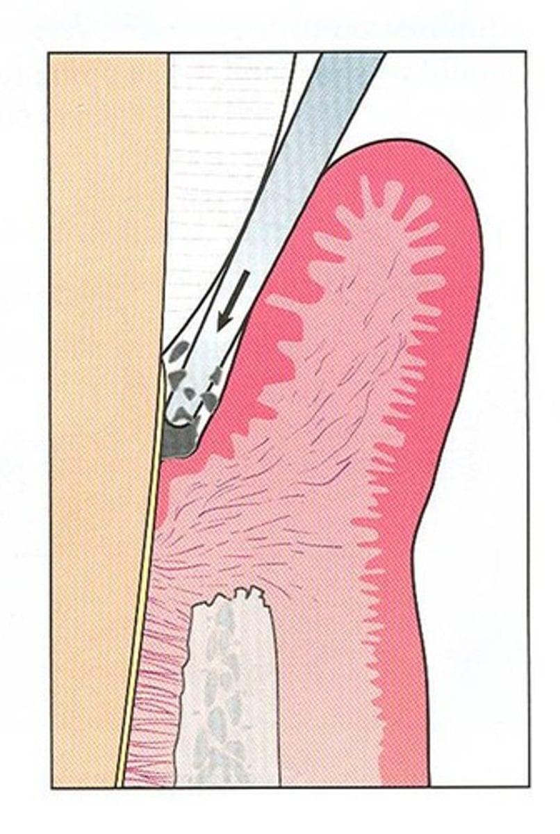 <p>•"Top down approach"</p><p>•from the top of the deposit working in an apical direction.</p>
