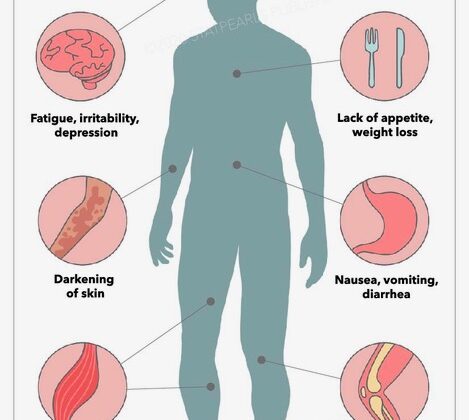 <p>Hyposecretory disorder of the adrenal cortex involving deficits in both glucocorticoids and mineralocorticoids.</p>
