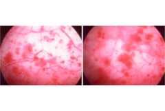 <p>Ulcerations found in interstitial cystitis patients on cytoscopy</p>