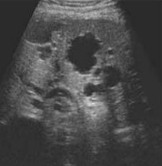 <p>what dx is this and describe the sonography</p>