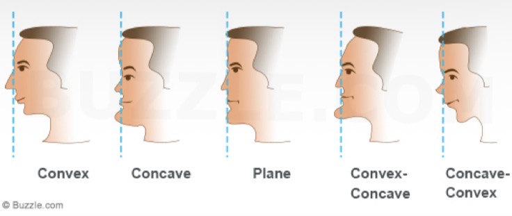 <p>Cephalometric analysis </p><p>Can be straight, convex or concave </p>