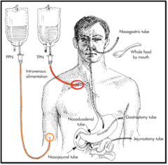 <p>-Administered through intravenous access with long-term usage requiring central venous catheter (CVC)</p><p>-Terminate in the heart for direct administration of nutrition</p><p>· Also used for medications and therapeutic procedures</p>