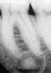 <p>adult F, periapical, florid, focal, no pain, teeth vital </p>