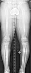 <p>Generally, not needed</p><p>X-ray if >6 cm varum/valgum and not following typical progression</p><p>Image should be from hip to the ankle</p><p>If unilateral, then MRI</p>