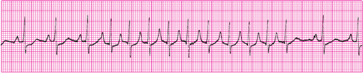 <p>What ECG is this? </p>