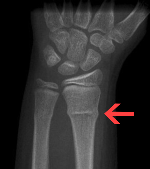 <p>compressive forces cause one side of bone cortex to buckle and bulge outward and other side remains intact</p>