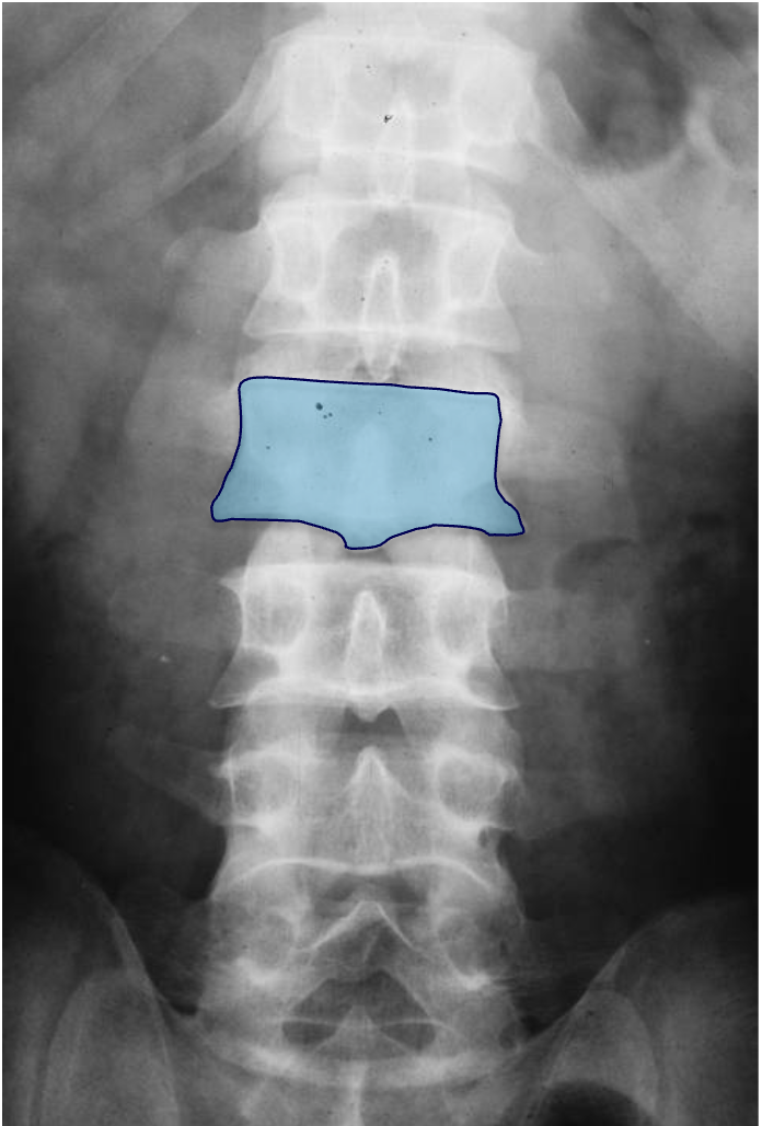 <p>What tumour like disorder is this, where is it, what can be seen?</p>