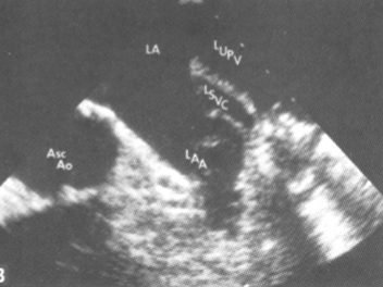 <ul><li><p><span style="color: red;">most common congenital anomaly that affects the systemic veins</span></p></li><li><p>The LSVC drains into the Coronary Sinus for blood to return to the RA</p></li><li><p>No tx is necessary</p></li><li><p>No complications</p></li></ul><p></p>