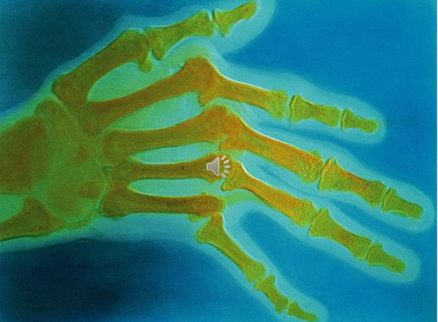 <p>What is the end result of RA?</p>
