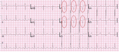 <ul><li><p>myocardial ischemia/onset of myocardial infarction</p></li></ul><p></p>