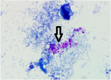 <p>Cytologie duodénale : diagnostic</p>