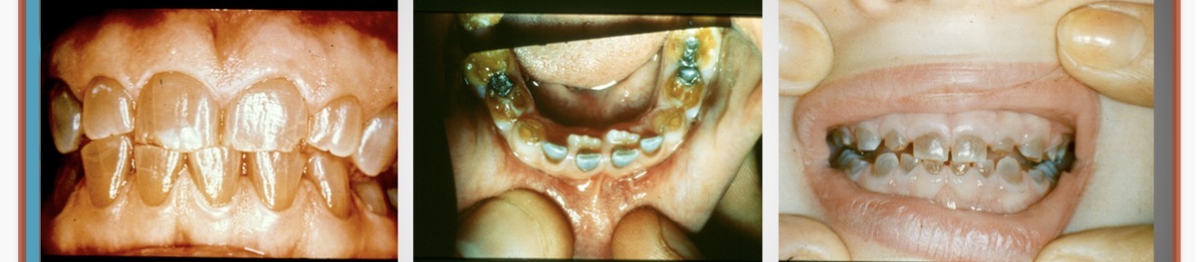 <p>Dentinogenesis imperfecta </p>