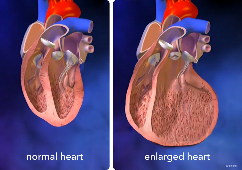 <p>An <strong>enlargement of the heart</strong>.</p>