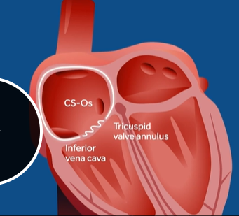 <p>reg conduction of the fast path and the isthmus between tricuspid valve and inferior vena cava called the CTI cavo tricuspid isthmus </p><p>travels CC around tricuspid annulus </p><p>sawtooth pattern 2:1, 3:1, or 4:1</p><p>atypical flutter: conducts Clockwise or in the LA</p>