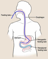 <p>Inserted in nares of the nose to provide supplemental nutrition</p>