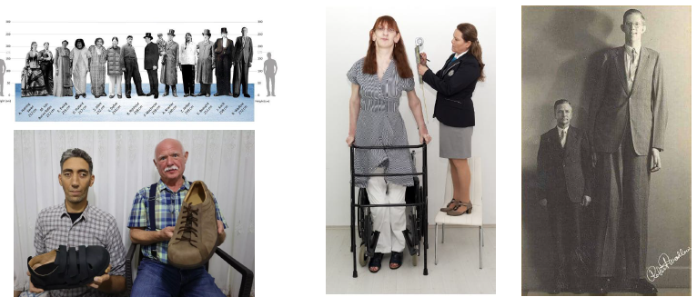 <ul><li><p>GH excess in childhood <strong>before epiphyseal closure</strong></p></li><li><p>marked with extreme height, long limbs, and large hands</p></li><li><p>disproportionate body growth and skeletal size</p></li><li><p>jaws enlarges with generalized macrodontia</p></li><li><p>oral structures with normal in form but enlarged</p></li></ul><p></p>