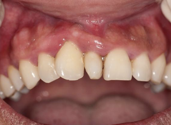 <p>most commonly occurs max incisors </p>