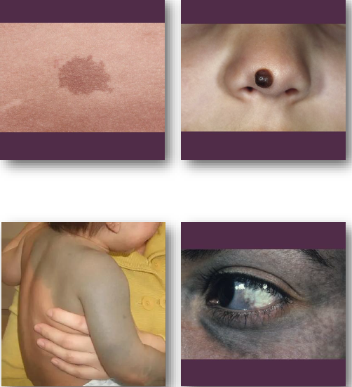 <ul><li><p><strong>Biopsy recommended for oral pigmented lesions</strong></p></li></ul><p>•Observe cutaneous lesions if typical in appearance</p><p>•<strong>Refer if lesion changes in size or color</strong></p><p>•Document baseline appearance carefully</p><p>•Small risk of malignant transformation exists</p><p></p>