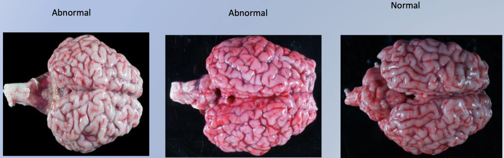 <p><u>Aetiology:</u> In utero infection with BVDV 60 - 180d of gestation</p><ul><li><p>Unknown herd BVD status</p></li></ul><p><u>Signalment:</u> Single neonate <7d</p><p><u>Clinical Signs:</u> Present at birth</p><ol><li><p>Recumbent</p></li><li><p>Strabismus and horizontal nystagmus</p></li><li><p>Reduced PLR</p></li><li><p>Tremours and convulsions</p></li><li><p>Ataxia</p></li><li><p>Torticollis and opisthotonus</p></li></ol><p></p>