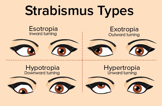 <p>Eye misalignment</p>