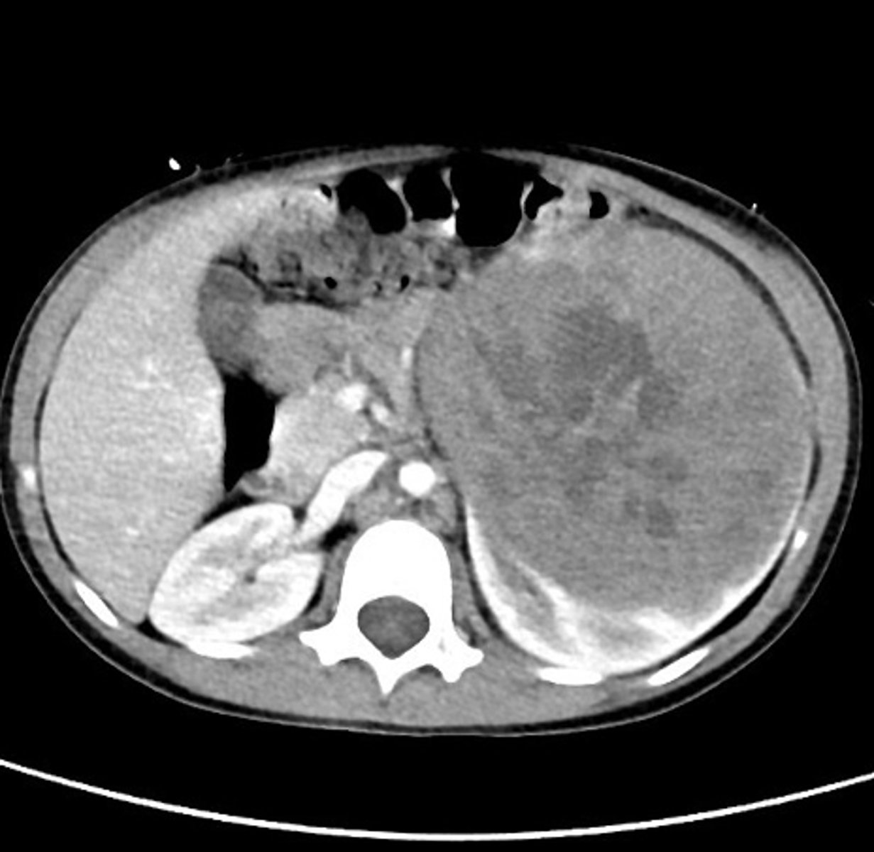 <p>Abdominal US: vascular infiltration</p><p>MRI/CT: Large, heterogeneous, mixed components</p><p>+/- metastasis</p>