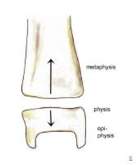 <p>A Transverse Fx along the Physis:</p><p>- Difficult to detect on plain films; look for pathological widening of the Physis</p><p>- May result in disrupted bone growth (rare)</p>