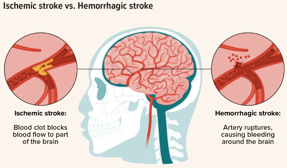 <p>Ischaemic (~80%)</p><ul><li><p>Thrombotic, Embolic, Systemic hypo-perfusion</p></li></ul><p>Haemorrhagic (~20%)</p><ul><li><p>Subarachnoid, Intracerebral</p></li></ul><p></p><p></p>