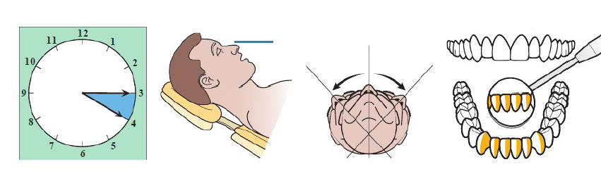 <ul><li><p>Clinician sits 3 to 4 o’clock position</p></li><li><p>Patient chin DOWN</p></li><li><p>Mandibular occlusal parallel to floor</p></li><li><p>Patient head: Neutral, left, or right</p></li></ul><p></p>