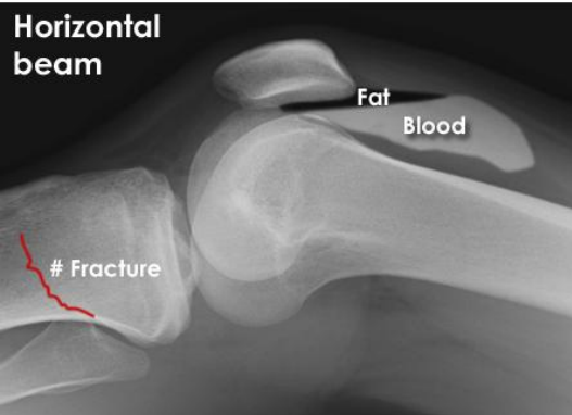 <p>presence of blood and fat in a joint cavity that nearly always signals an acute intra-articular fracture</p>