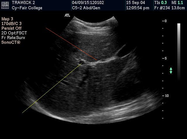 <p><strong>The yellow line points to the</strong></p><p>IVC</p><p>Aorta</p><p>Portal vein</p><p>Rt Renal artery</p>