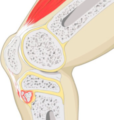 <p>- Thick, indurated patellar tendon (palpable)</p><p>- Prominent tibial tubercle</p><p>- Pain with resisted knee extension</p>