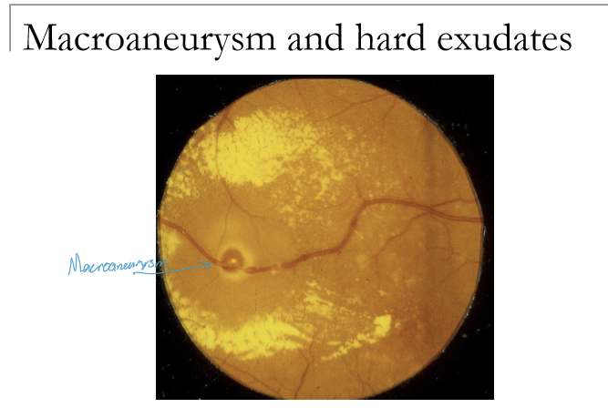 <p>A dilation of a major retinal arterial branch. It is associated with arteriosclerosis, retinal emboli, can be congenital. </p>