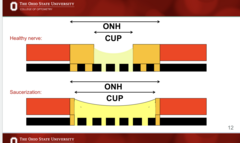 <p>Healthy vs Saucerization of ONH (Pic)</p>