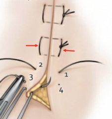 <p>For wide papilla.</p><p>(Explanation: Wide papillae require broader tension distribution, which horizontal mattress sutures provide by piercing tissue mesiodistally, stabilizing larger interdental areas.)</p>