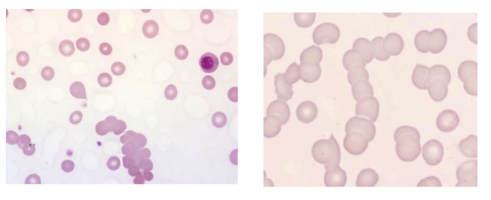<p>Name these 2 types of abnormal RBC distribution</p>