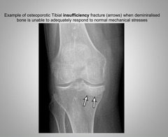 <p>Insufficiency Fracture</p>