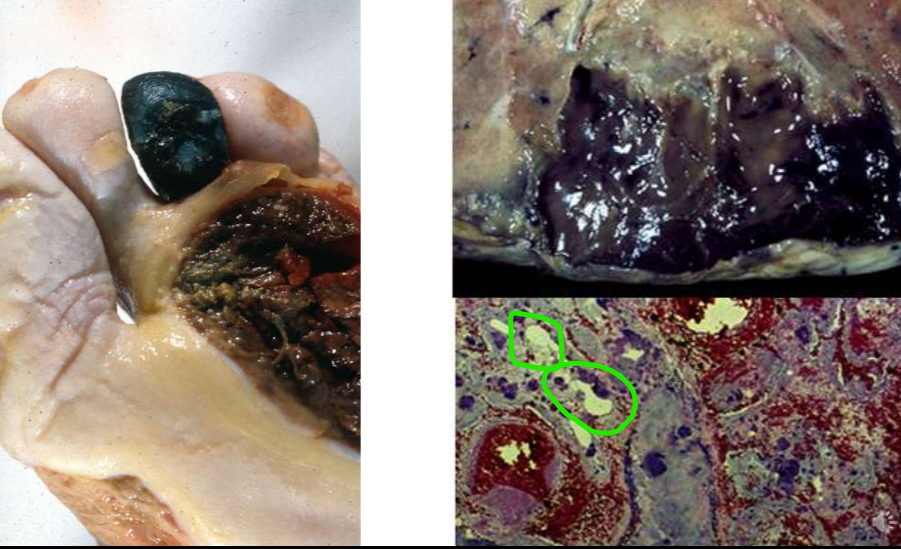 <ul><li><p>išemija + bakterinė infekcija</p></li><li><p>audinys tamsus ir šlapias, minkštas, pūliuoja</p></li><li><p>mikroskopiškai matosi violetinės bakterijos prie pūlių</p></li></ul><p></p>