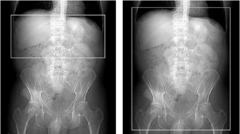 <p>Start location: 2 cm above kidneys End location: 2 cm below kidneys</p>