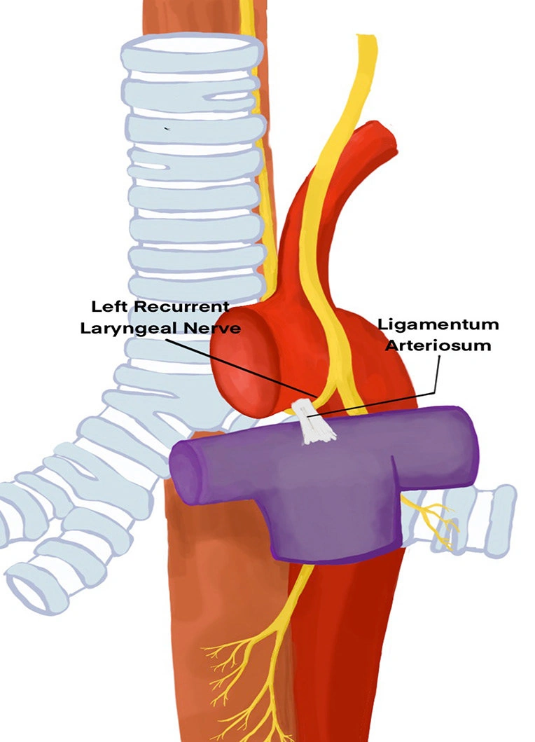 <p>What connects arch of aorta to the pulmonary artery?</p>