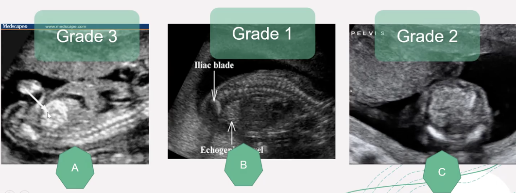 <ul><li><p>echogenicity similar to bone</p></li><li><p>typically compared to iliac crest</p><ul><li><p>grade 1: mildly echogenic and typically diffuse</p></li><li><p>grade 2: moderately echogenic and typically focal</p></li><li><p>grade 3: very echogenic, similar to that of bone structures</p></li></ul></li></ul><p></p>