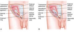 <p>Tunnel medial and parallel to the inguinal ligament forming a pathway for the vas deferens.</p>