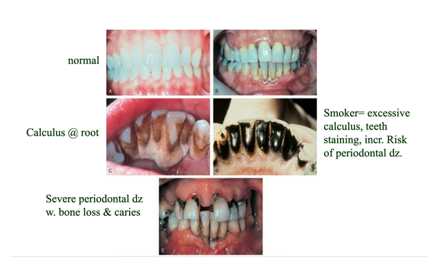 <ul><li><p><span style="background-color: transparent;">Plaque-bacterial sheet</span></p></li><li><p><span style="background-color: transparent;">Caries (cavities)</span></p></li><li><p><span style="background-color: transparent;">Gingivitis</span></p><ul><li><p><span style="background-color: transparent;">Surface</span></p></li><li><p><span style="background-color: transparent;">early</span></p></li></ul></li><li><p><span style="background-color: transparent;">Periodontal disease</span></p><ul><li><p><span style="background-color: transparent;">Roots</span></p></li><li><p><span style="background-color: transparent;">advanced</span></p></li></ul></li><li><p><span style="background-color: transparent;">Tartar/calculus</span></p><ul><li><p><span style="background-color: transparent;">Hardened plaque</span></p></li></ul></li></ul><p></p>