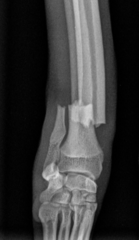 <p>Describe the fracture's orientation</p>