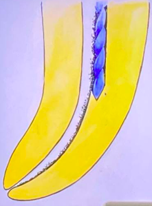 <p>an artifically created <span>irregularity on the surface of the root canal wall that prevents the placement of instruments to the apex of an otherwise patent canal</span></p>