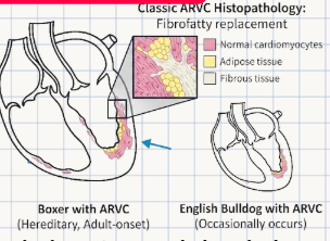 <p>It is an <strong>inherited heart disease</strong> where <strong>fatty or fibrous tissue</strong> physically <strong>replaces</strong> normal heart muscle particularly in the right ventricle</p>