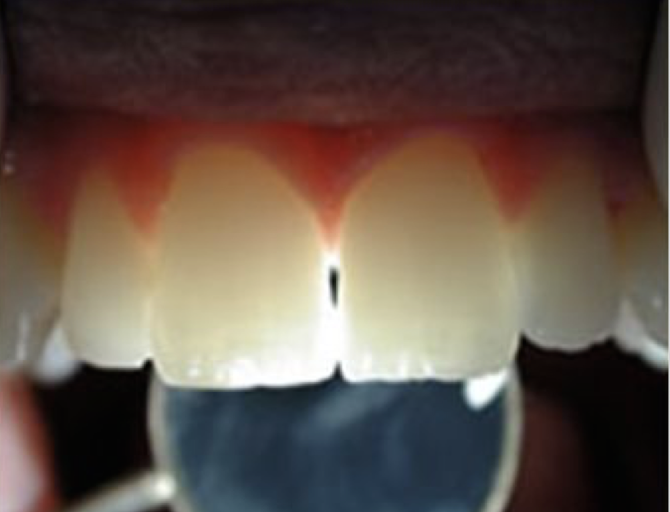 <p>Directing light off the mirror surface through the anterior teeth</p>