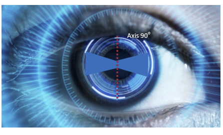 <p>With an axis near 90°, the thicker meridian is approximately parallel to the upper eyelid.<br>Because the lid does not strongly push against an angled thick edge, there is often minimal rotational force and little rotation.</p>
