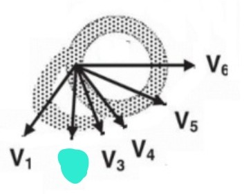 <p>4th intercostal space, left sternum  만나는 지점</p>