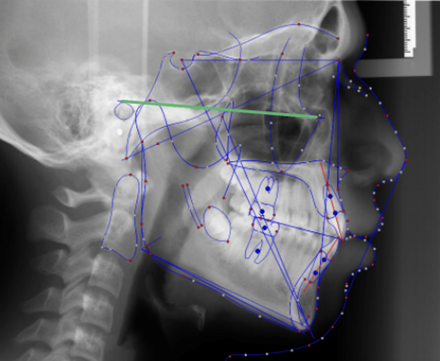 <p>which reference plane:</p><p>- Porion to Orbitale</p><p>- Cranial base reference line</p><p>- "Natural head position"</p><p>- Should be parallel to the floor when the patient "looks off into the horizon"</p>